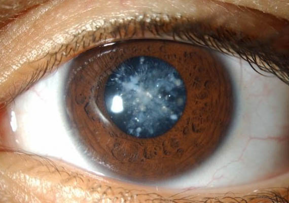Prof. Dr. Fehmi Cem Küçükerdönmez, Retina Hastalıkları ve Retina Cerrahisi - İzmir Göz Doktoru