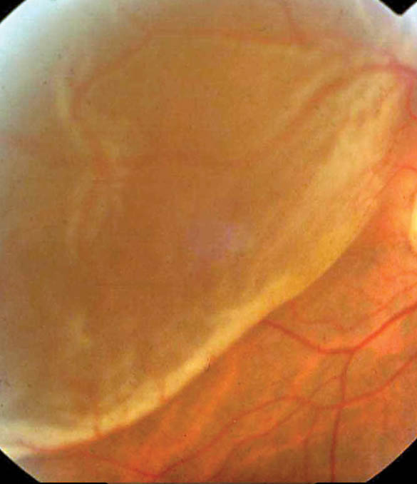Prof. Dr. Fehmi Cem Küçükerdönmez, Retina Hastalıkları ve Retina Cerrahisi - İzmir Göz Doktoru