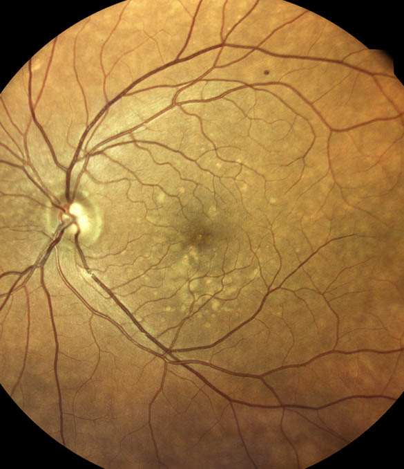 Prof. Dr. Fehmi Cem Küçükerdönmez, Retina Hastalıkları ve Retina Cerrahisi - İzmir Göz Doktoru