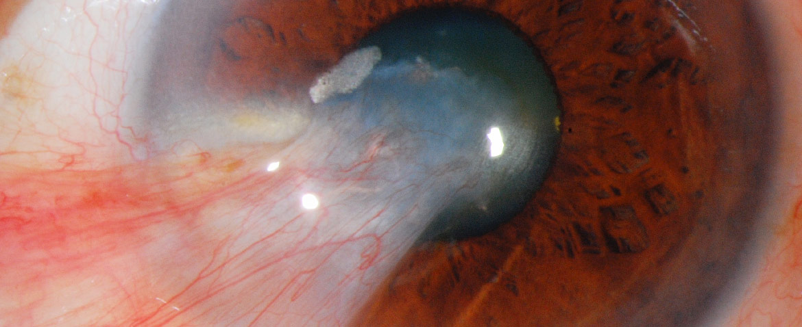 Prof. Dr. Fehmi Cem Küçükerdönmez, Retina Hastalıkları ve Retina Cerrahisi - İzmir Göz Doktoru